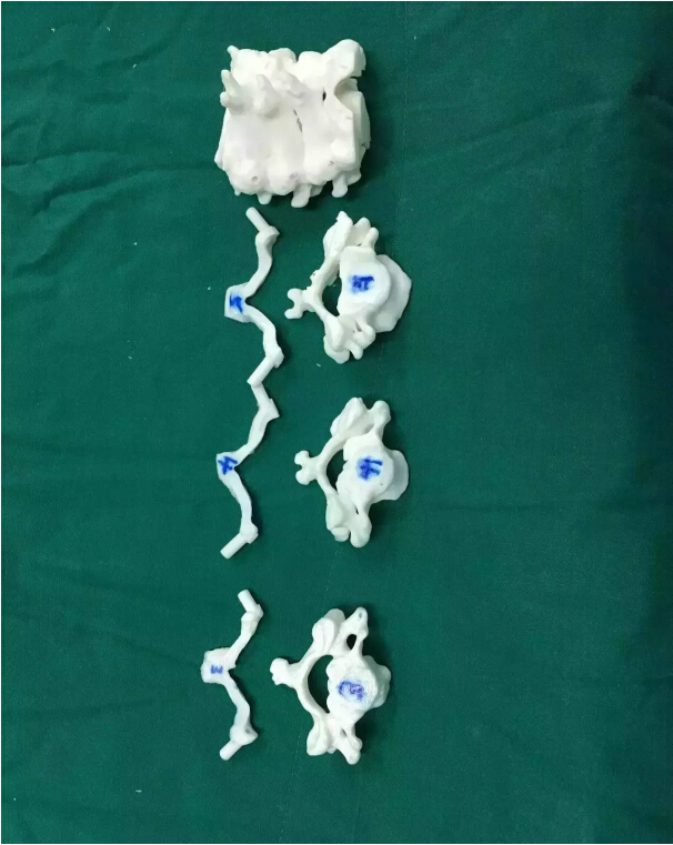 3D打印置釘導(dǎo)板輔助下完成下頸椎椎弓根螺固定手術(shù)